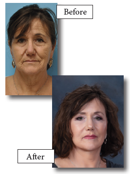 MEDICAL MINUTES<br>The Full Facelift What It Really Means